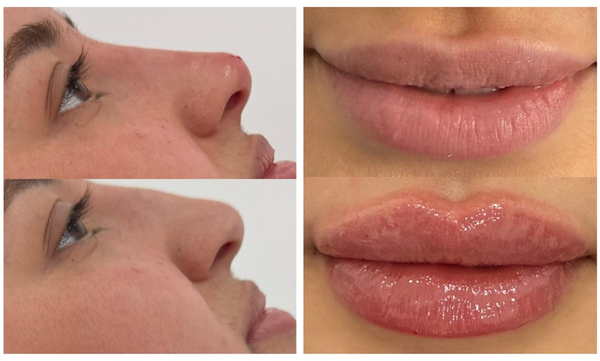 Image 3: Up to 75% off Signature Dermal Filler for Lips & Face - 1ml up to 2ml
