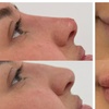 Image 3: Up to 75% off Signature Dermal Filler for Lips & Face - 1ml up to 2ml
