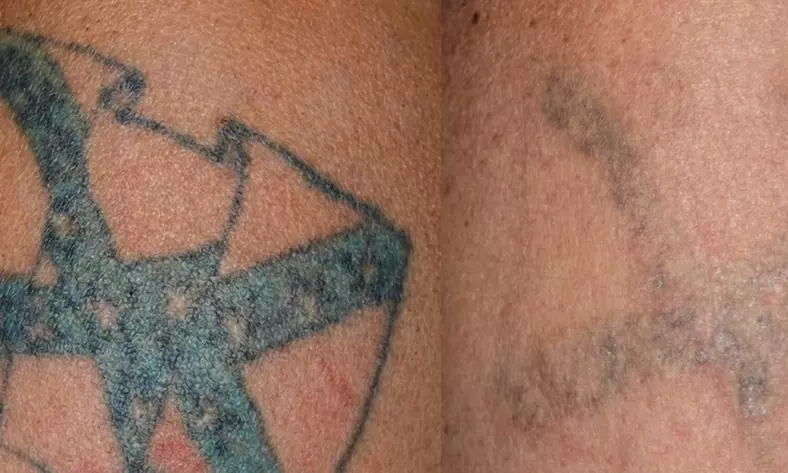 Laser Tattoo Removal on a Small, Medium, Large, or Extra Large Area!