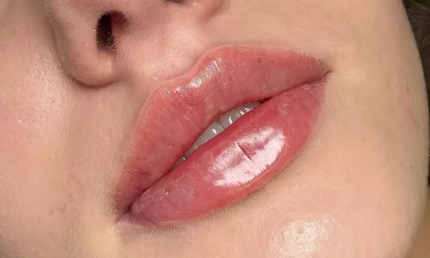 Image 1: Enhance Your Beauty with 1ml or 2ml Dermal Filler