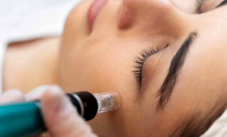 Image 4: Sesiones de rehidratación de labios, Dermapen facial y exosomas