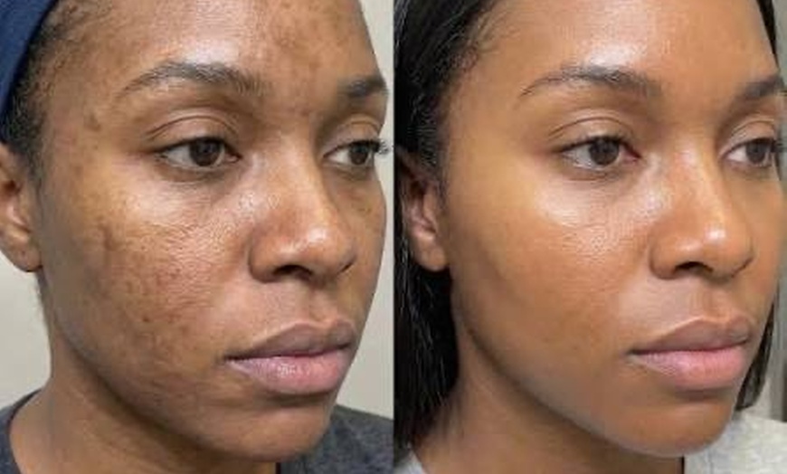 Image 3: LED, peeling, hydratation, anti-âge : soin visage au choix à Bruxelles