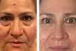 Rejuvenate with One, Three, or Six 60-Min IPL Facial Sessions at DALA Med Spa and Save Up to 55% Off on - Second Medium
