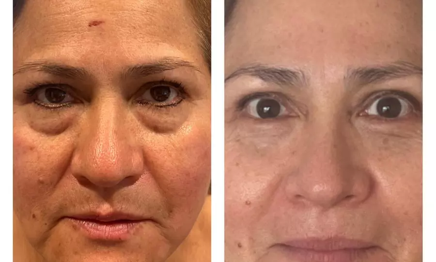 Transform Your Skin w/ One, Three, or Six 60-Min IPL Facial Sessions