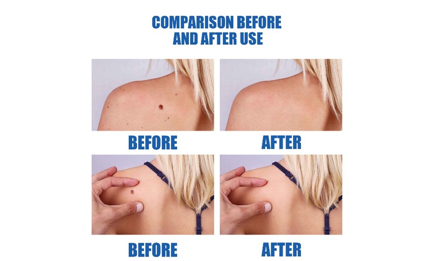 Image 5: Skin Mole Removal Pen