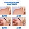 Image 5: Skin Mole Removal Pen