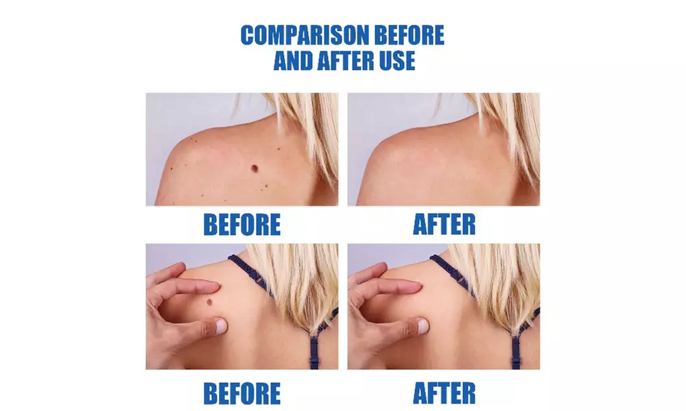 Skin Mole Removal Pen