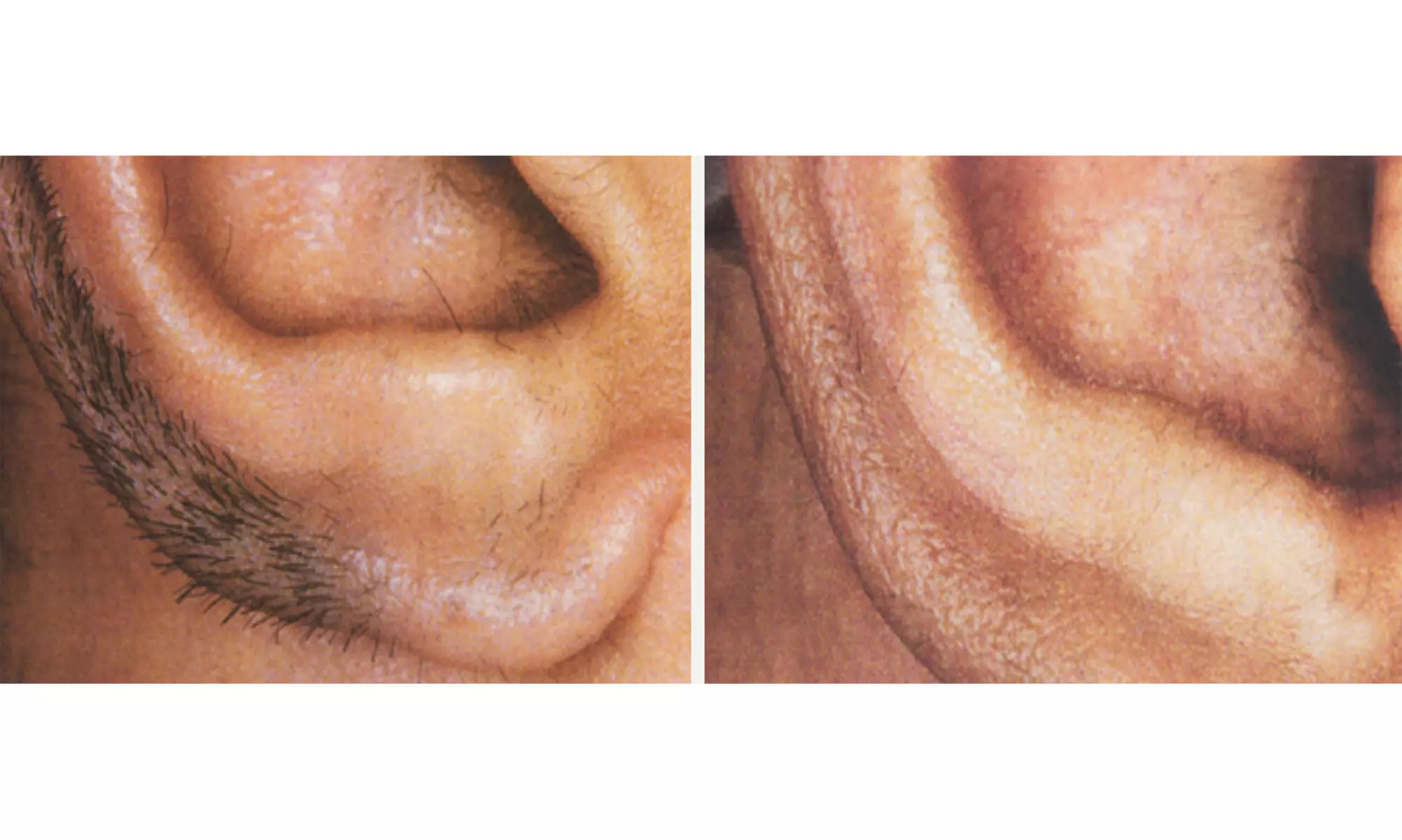 3 Laser Hair Removal Sessions for Small, Medium or Large Area