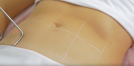 One TriLift Body Treatment - Sense Skincare And Wellness