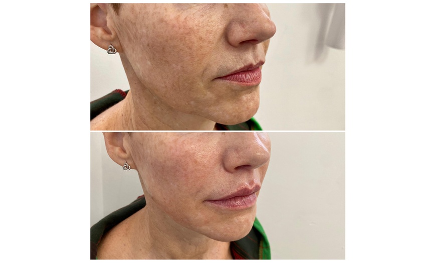 Image 3: ¡Infiltración de relleno dérmico con opción a blanqueamiento dental!