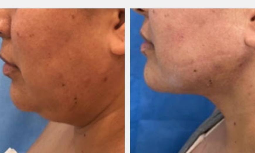 Image 2: Liposuction for Chin with Post Op Care Included. 