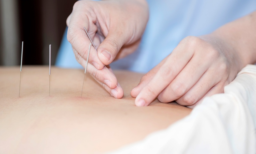Image 3: Lymphatic Drainage, Acupuncture & Deep Tissue Sessions — Solo / Couple