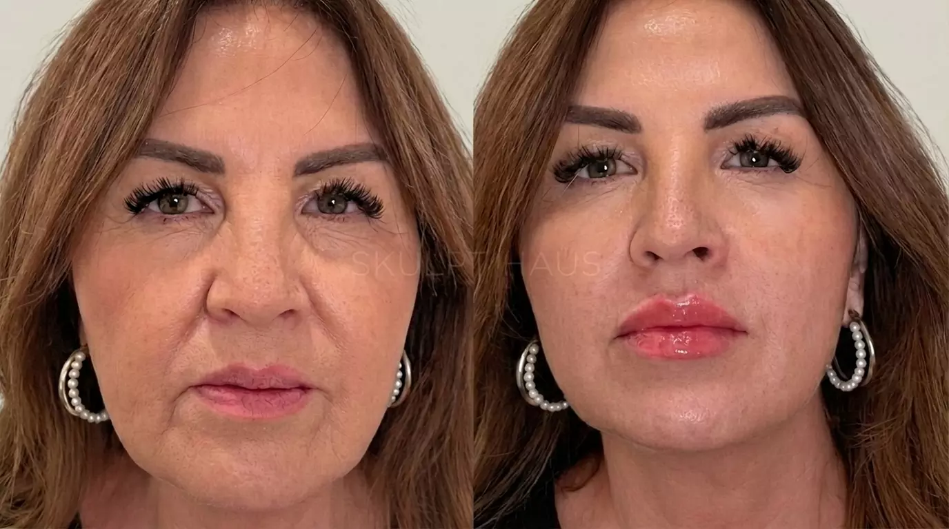 Revitalize with PRP / PRF / EZ Gel for Smile Lines or Under Eyes or 3 Sessions of PRP /PRF Package(Up to 37%Off) - Primary Image