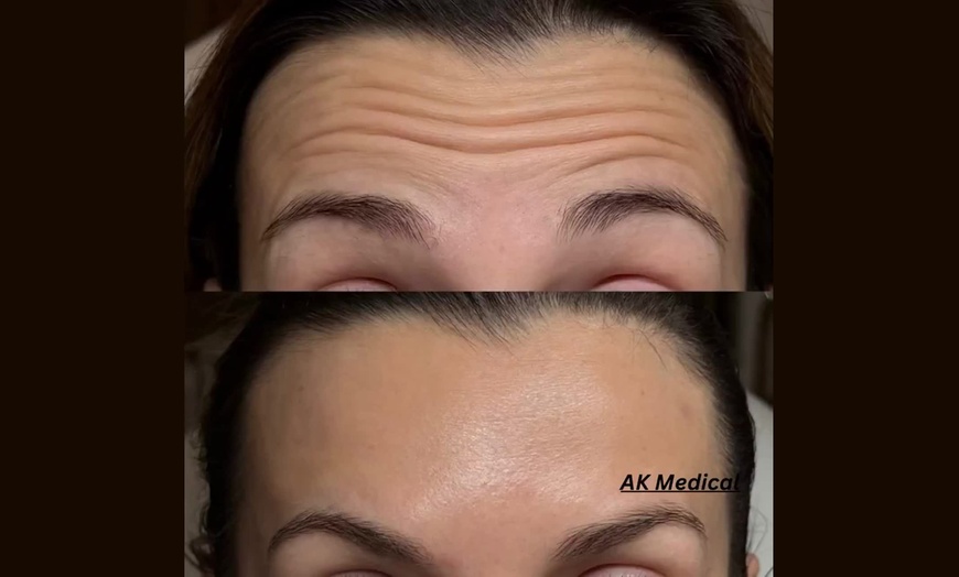 Image 3: Smooth & Plump: Botox and Juvéderm Custom Aesthetic Packages