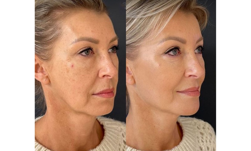 Image 3: Non-Surgical Facelift Treatments