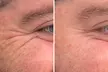 Transform Your Look with 30 or 60 Units of Dysport at Youthful Glow ( Up to 51% Off ) - Second Medium