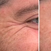 Image 2: Revitalize with 30 or 60 Units of Dysport at Youthful Glow