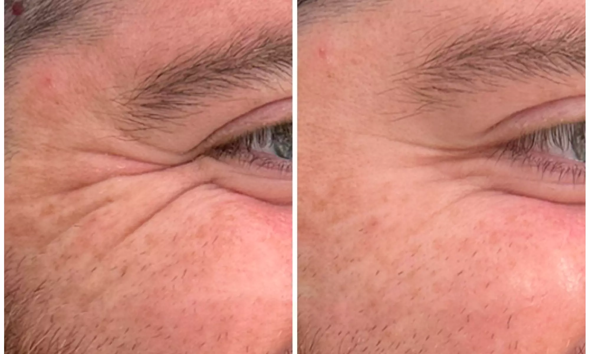 Revitalize with 30 or 60 Units of Dysport at Youthful Glow