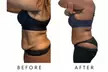 Precision Slim Laser Fat Loss & Skin Tightening – Non-Invasive Body Contouring Up to 58% Off at Your Sculpt Studio DC - Second Medium