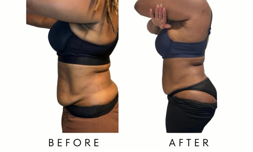 Image 5: Precision Slim Laser Fat Loss & Skin Tightening, Your Sculpt Studio DC