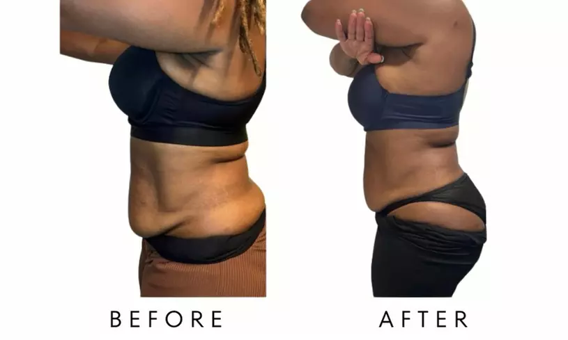 Precision Slim Laser Fat Loss & Skin Tightening, Your Sculpt Studio DC