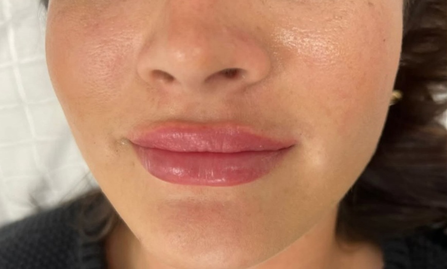 Image 4: 1 or 1.5 Syringe Restylane Kysse Lip Filler + Optional 20U Xeomin