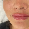 Image 4: 1 or 1.5 Syringe Restylane Kysse Lip Filler + Optional 20U Xeomin