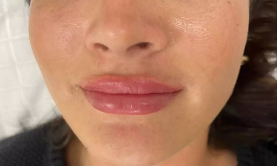 1 or 1.5 Syringe Restylane Kysse Lip Filler + Optional 20U Xeomin
