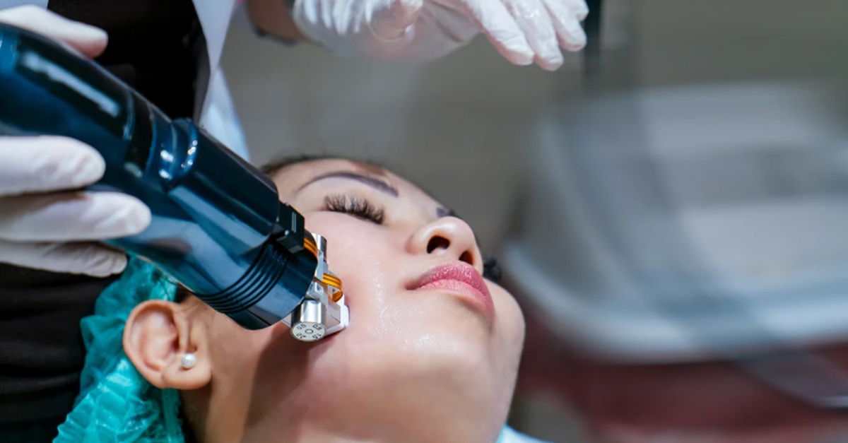 88% off RF Microneedling for Face or Under Eyes for Smoother, Firmer-Looking Skin at Ms Slim