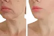 Zen Beauty – Non-Surgical HIFU Facelift & Eye/Mouth Lift: Up to 67% Off - Second Medium