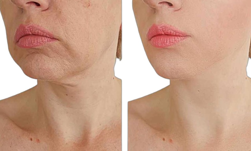 Image 7: Up to 67% Off on Facelift - Non-Surgical at Zen Beauty Ltd