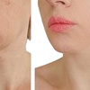 Image 7: Up to 67% Off on Facelift - Non-Surgical at Zen Beauty Ltd