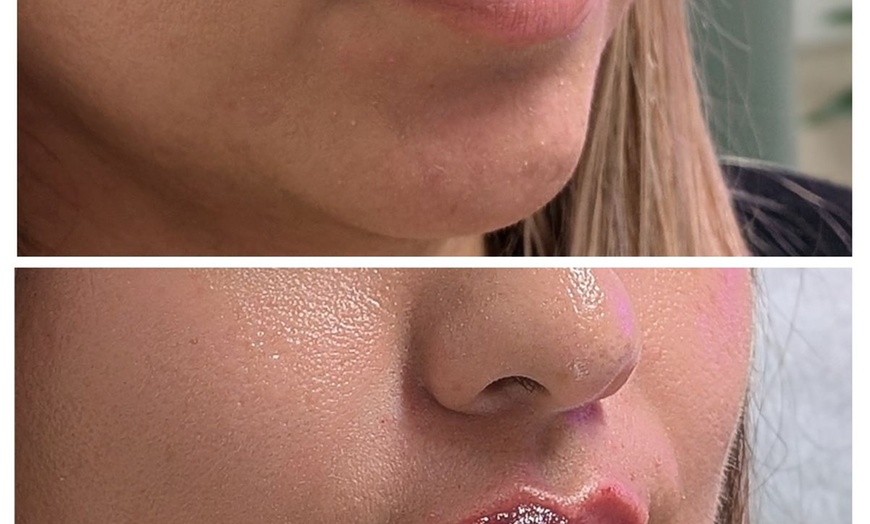 Image 3: Enhance with 20, 40 Units of Botox or Lip Flip (Up to 10 Units)