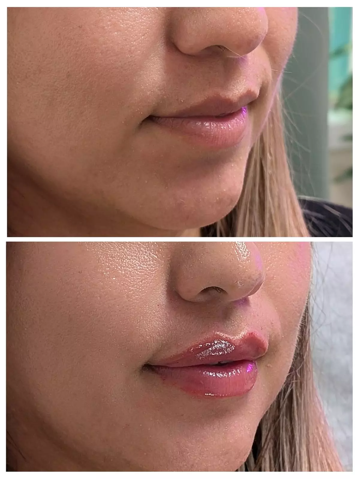 Enhance with 20, 40 Units of Botox or Lip Flip (Up to 10 Units)