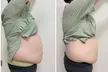 4 or 6 30-Minute Cavitation or 4 60-Minute Custom Ultrasonic Cavitation Fat Removal Treatments (Up to 64% Off) - Second Medium