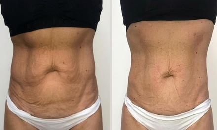 Four Laser Lipo Treatments - Body By Lily