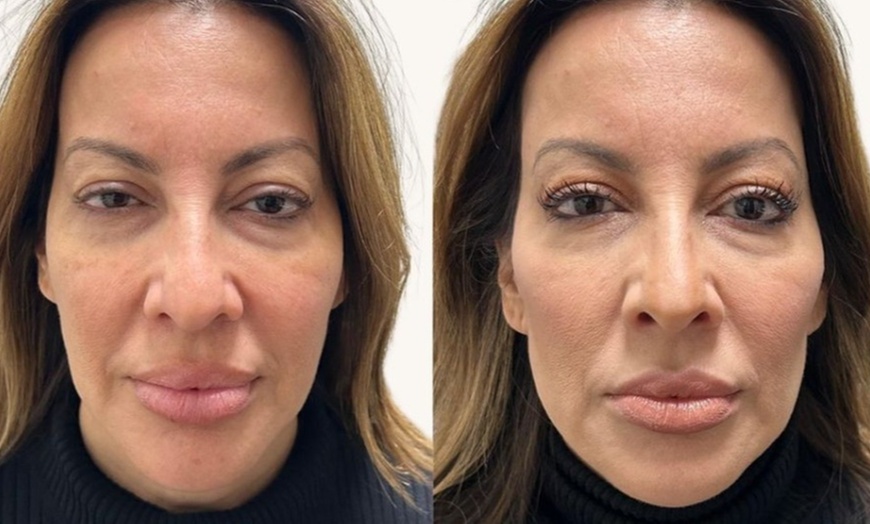 Image 3: Up to 40% Off Botox at Botox and Beauty Boutiques