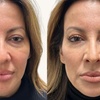 Image 3: Up to 40% Off Botox at Botox and Beauty Boutiques