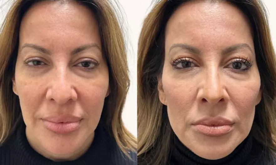 Up to 40% Off Botox at Botox and Beauty Boutiques