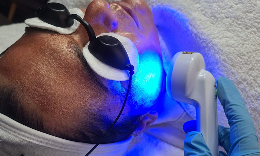 Image 5: One Microdermabrasion or Fill Up 360 Microneedling with LED Therapy!