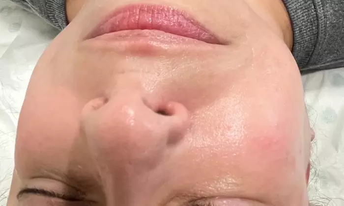 Achieve Radiant Skin with Aero Laser and Skin's Dermaplaning and More Options Up to 55% Off - Second Medium