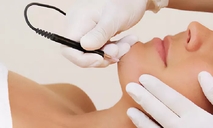 One or Two 30-Minute Electrolysis Hair Removal Sessions