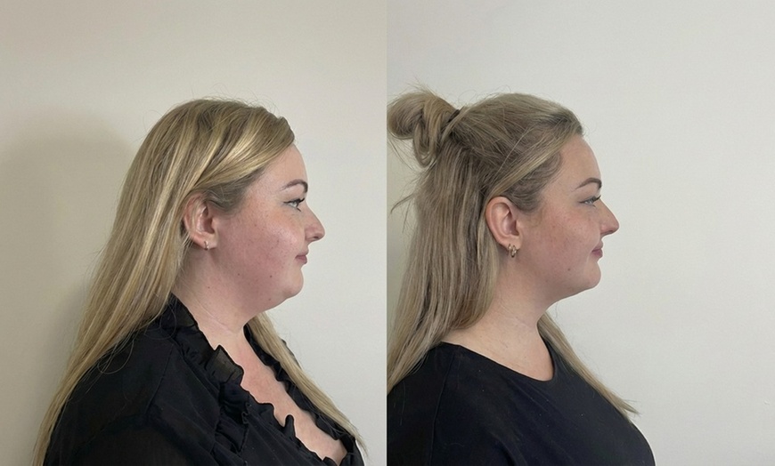 Image 2: Kriolipoliza podbródka – modelowanie bez skalpela