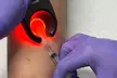 Consult, Ultrasound, Sclerotherapy Spider Vein Removal Injection (10cc) for a 2x2 Area (45-Min) (Up to 55% Off) - Second Medium