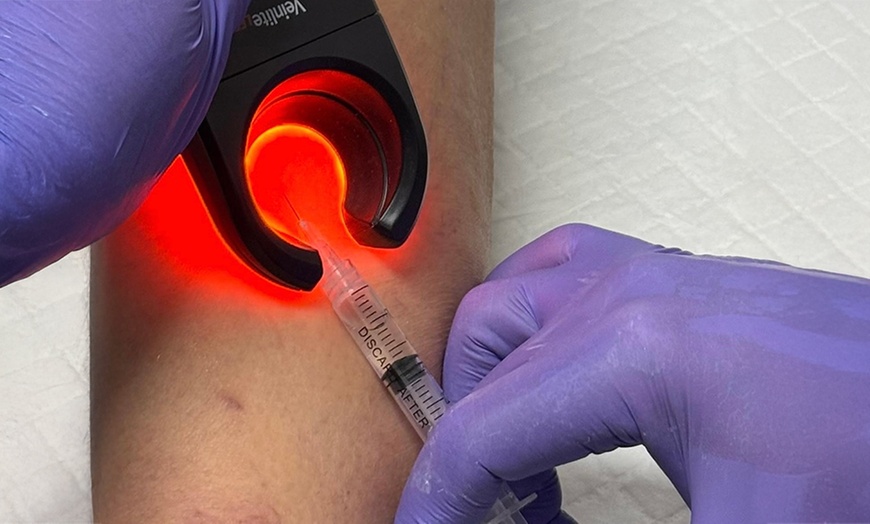 Image 4: Consult, Ultrasound, Vein Removal Injection (10cc) for a 2x2 Area