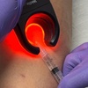 Image 4: Consult, Ultrasound, Vein Removal Injection (10cc) for a 2x2 Area