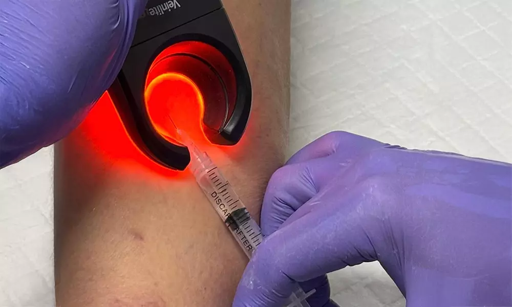 Consult, Ultrasound, Vein Removal Injection (10cc) for a 2x2 Area