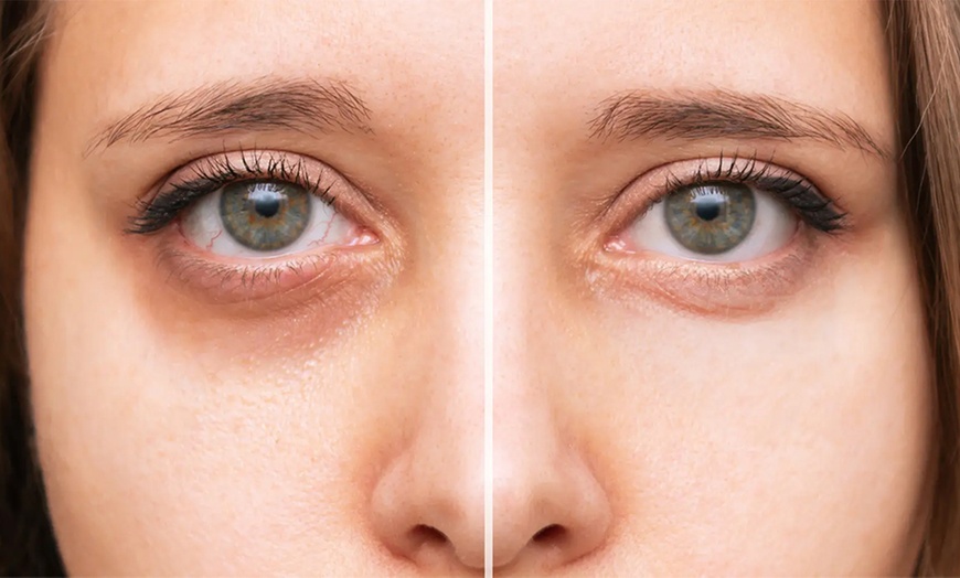 Image 2: Revitalize with One, Two, or Three Sessions of Lumi Eyes / Mesotherapy