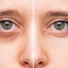 Image 2: Revitalize with One, Two, or Three Sessions of Lumi Eyes / Mesotherapy