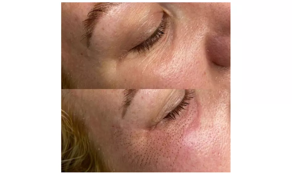 Up to 70% Off on Injection - Plasma at Organik Laser & Beauty